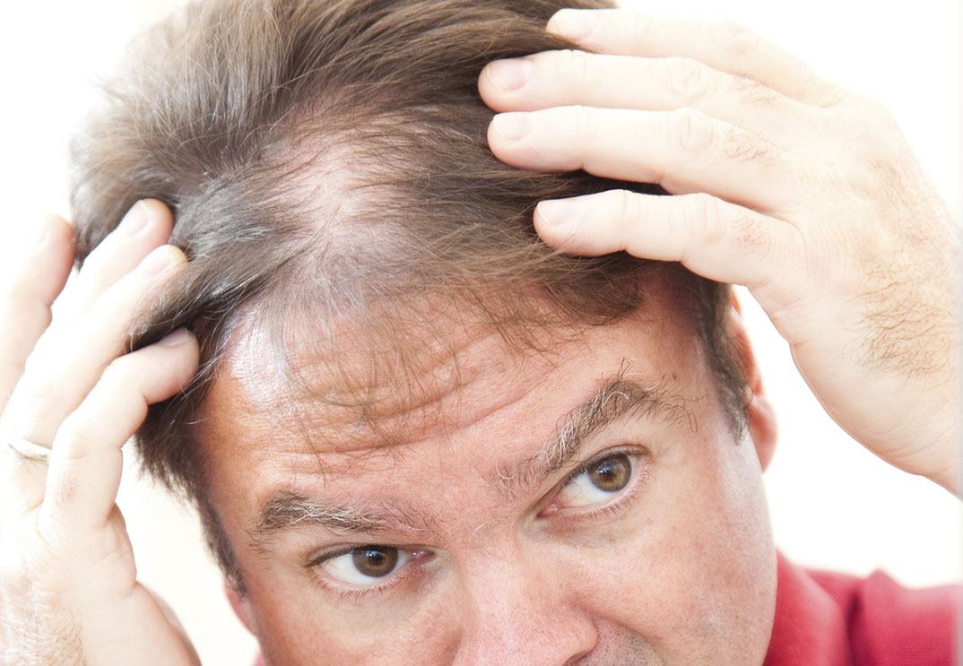 Причины выпадения волос у подростка. Поредение волос у мужчин.